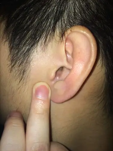 耳朵里长了一个这种玩意,跟痘痘差不多,一挤还有白色的东西出来,不