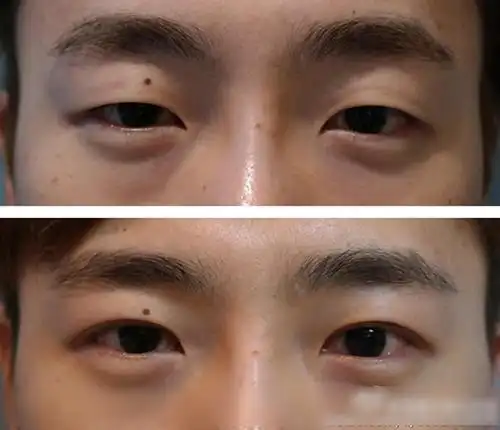 韩国清潭李康元男士眼整形前后对比照片