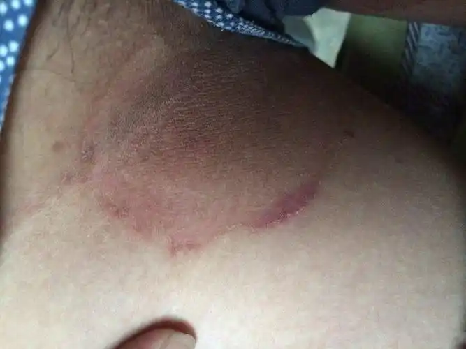 后背体股癣图片_有来医生