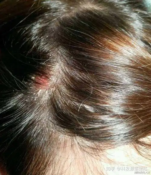 18岁女生 脱发 头发根部有油脂粒 一扣就掉 有什么改善方法?