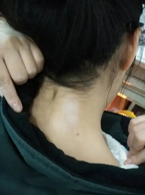颈部后面长了一片白色的东西,听说是癣,可是我不知道是什么,能治愈么?