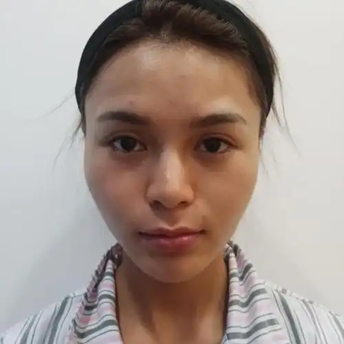 我做的是颧骨降低手术,没做之前的时候颧骨两边还是有_圈子-新氧美容