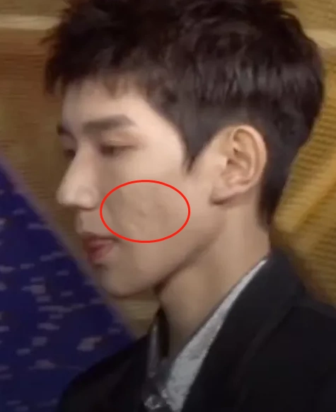 王源"烂脸"被吐槽重度痤疮?镜头拉近让人不敢相信,你才19啊