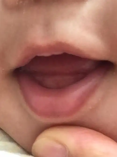 长牙有什么征兆牙龈变白了