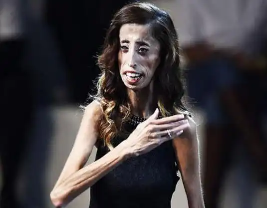 世界上最瘦的人是谁体重仅54斤的美国零脂肪女孩