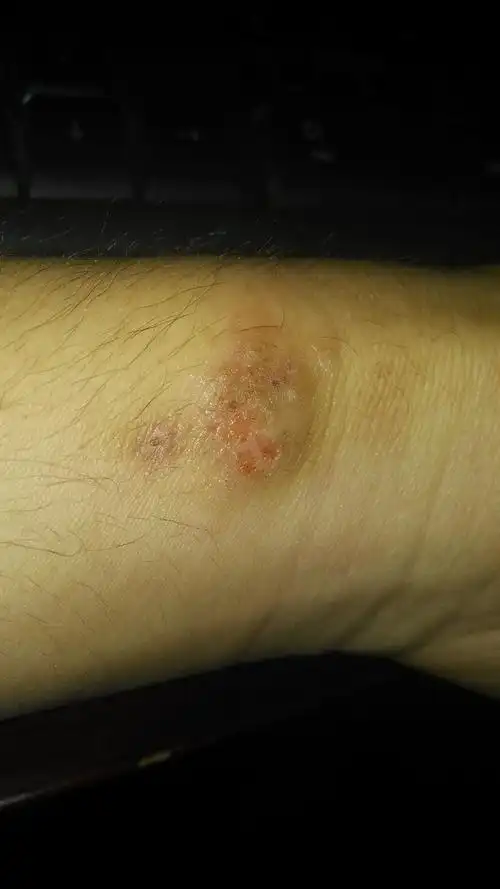 反复的皮肤溃烂_百度知道