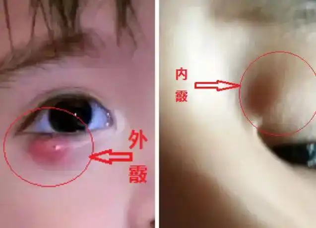 霰粒肿vs麦粒肿,您分得清楚吗?