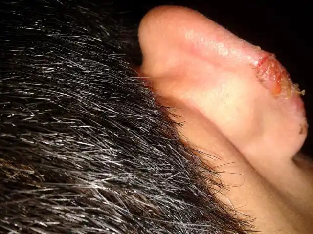 耳朵上有皮肤病 ,淌黄水,结痂,去了好多医,一直没什么好效果,想请教