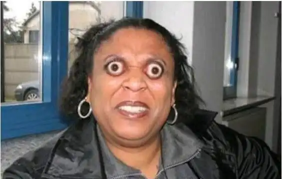 世界上眼球最突出的女人金古德曼突出眼眶11毫米