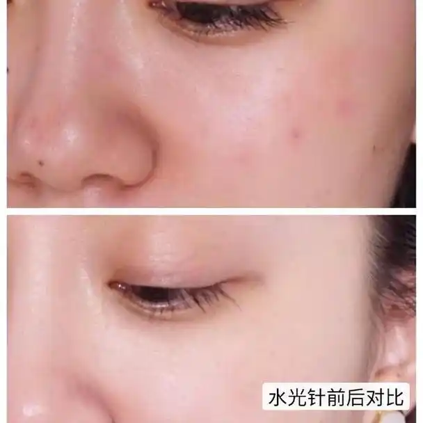打完水光针的皮肤效果,强烈推荐
