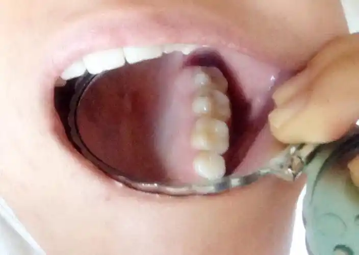 问: 100 11岁的时候整过牙,下面没拔,上面拔了左右虎牙后面的两颗.