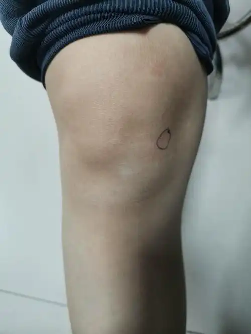 膝关节内侧皱襞综合征