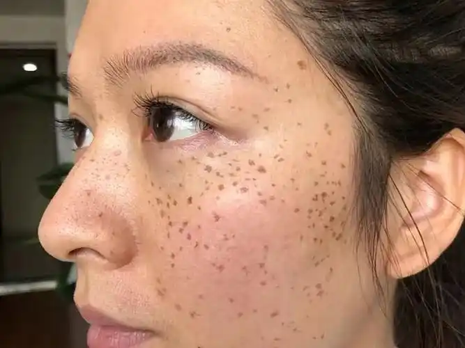 从小学开始长斑的,长的还是一大片,尴尬…然后前几天_圈子-新氧美容整