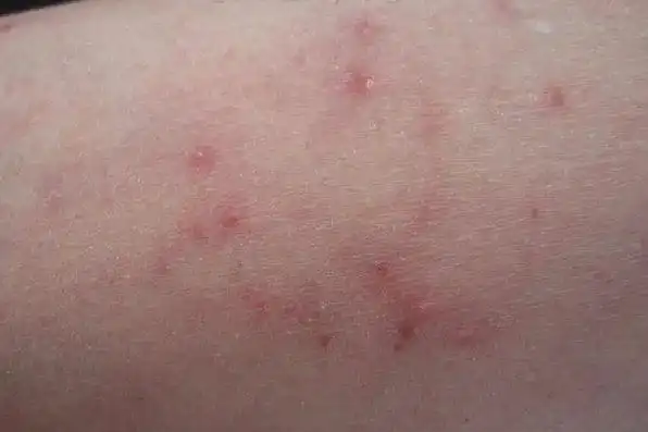 毛囊炎的早期症状图片_图文_文章_美咯_让您放心美!