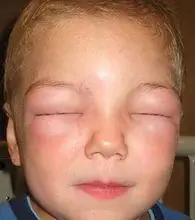 肾脏病水肿的特点是晨起眼睑或颜面水肿,午后多消退,劳累