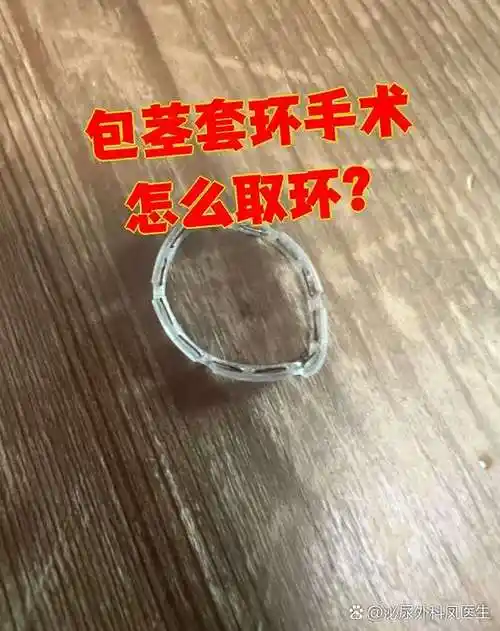 包茎套环手术(包皮环切术)后需要到医院取环