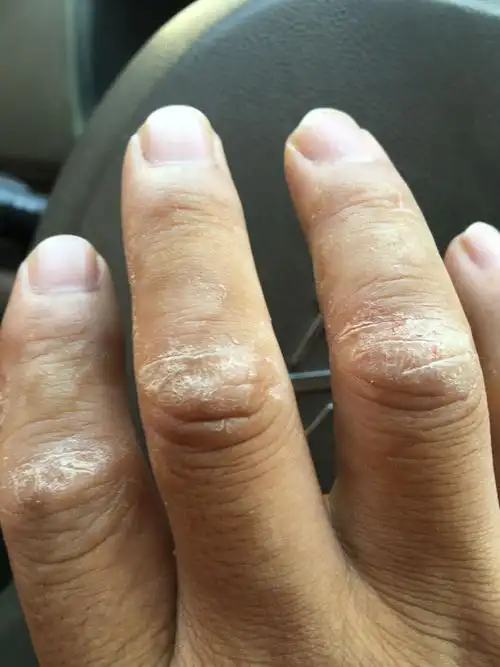 呃我的手指关节痒裂口,怎么回事,怎么治疗