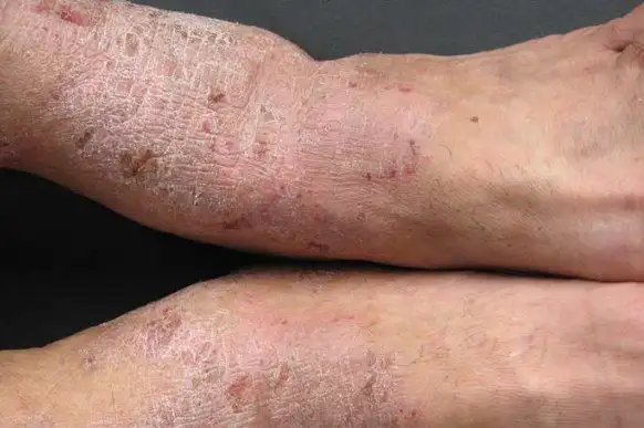 脚部湿疹初期症状图片