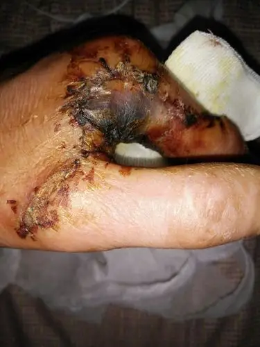 手指受伤了,已经一个月了,局部黑黑的(可能坏死),其余肉也硬硬的,没啥