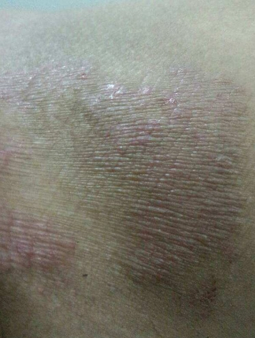 体股癣初期现象图片 (3)