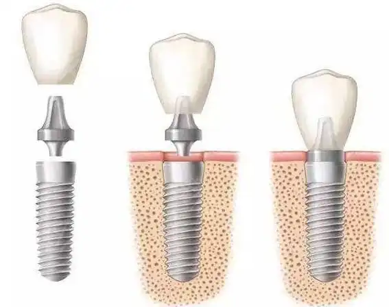 医生说|做种植牙要多少钱?能不能刷医保?