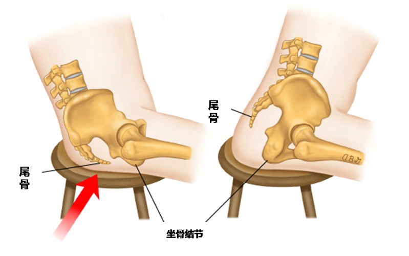 yǐ巴骨(尾骨)受伤后,总是疼好不了怎么办?骨科医生告诉你