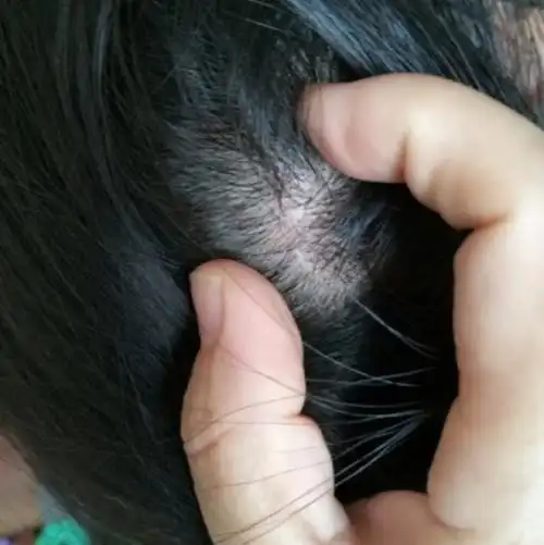 头皮屑多且大块还结痂