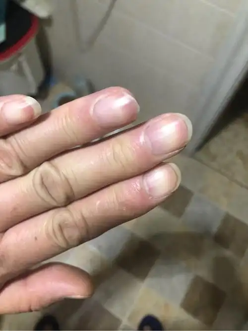 结疗9个多月,今天早晨发现平时正常的指甲变紫-淋巴瘤之家