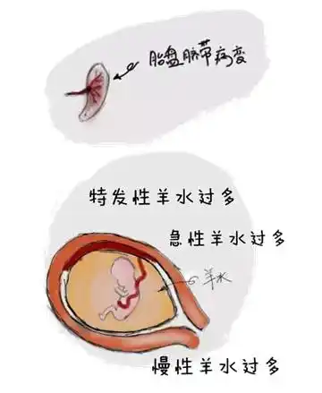 胎儿的尿液,呼吸系统,胃肠道,脐带,胎盘表面等,都成为羊水的来源