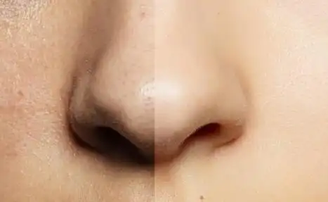 脸部毛孔粗大怎么办收缩毛孔办法有哪些