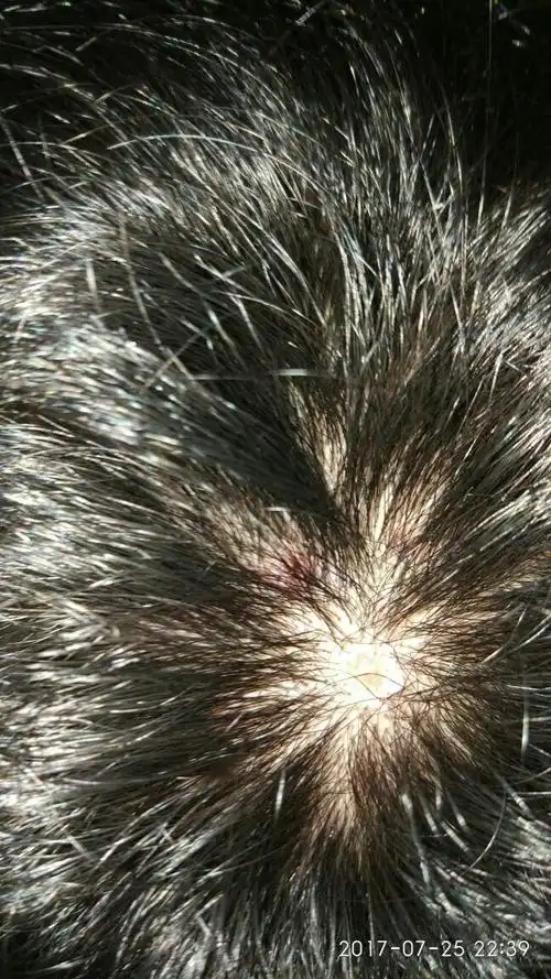 头顶总是长疙瘩,痒,每次都挠破了