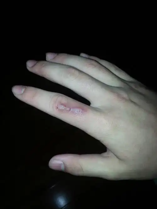 我手上有条蛮长的伤疤 想买个戒指遮住 该买什么样的?