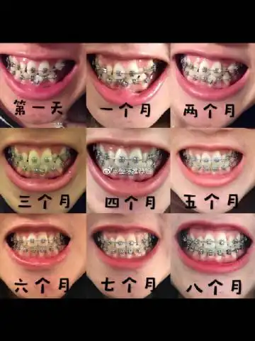 金属自锁牙套和隐适美隐形牙套矫正大概需要多少钱呢?