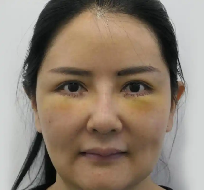 来看看#泪沟填充# 前,术后4天,术后30天是怎么样的吧!