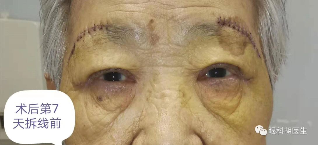 老年人上眼皮垂下来,遮挡视野怎么办_上睑下垂_上睑下垂治疗方式 - 好