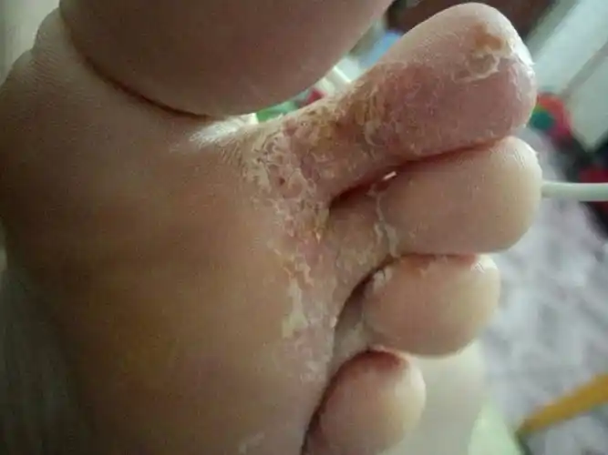 为什么达克宁擦了没用.后四个脚趾还是脱皮越来越严重.