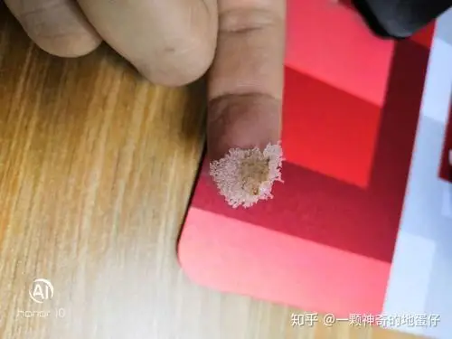 见过的最大头皮屑多大?