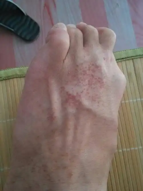 脚上出来了许多小红点,不疼不痒,只在袜子以内部位皮肤,出来俩月了