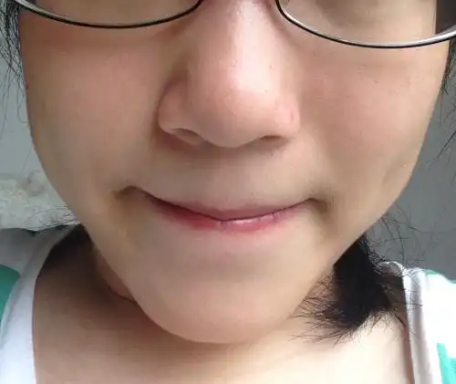 今年高一,不想通过手术和整容作为治疗.请问有什么方法可以让鼻头