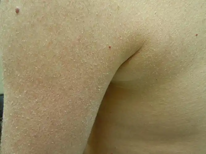 角样鱼鳞病图片_有来医生