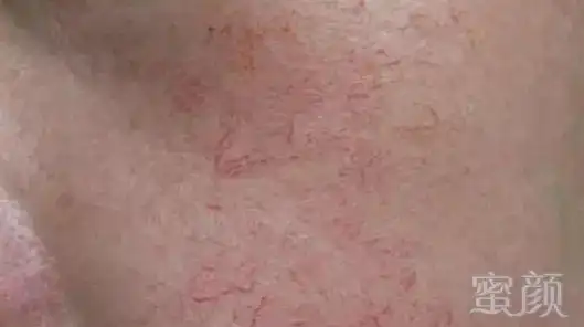 新闻列表 红血丝到底该怎么修复?    树枝和网状