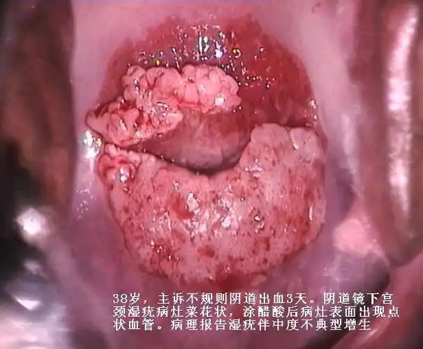 【分享】尖锐湿疣高清晰图片 - 皮肤及性传播疾病讨论版 - 爱爱医医学