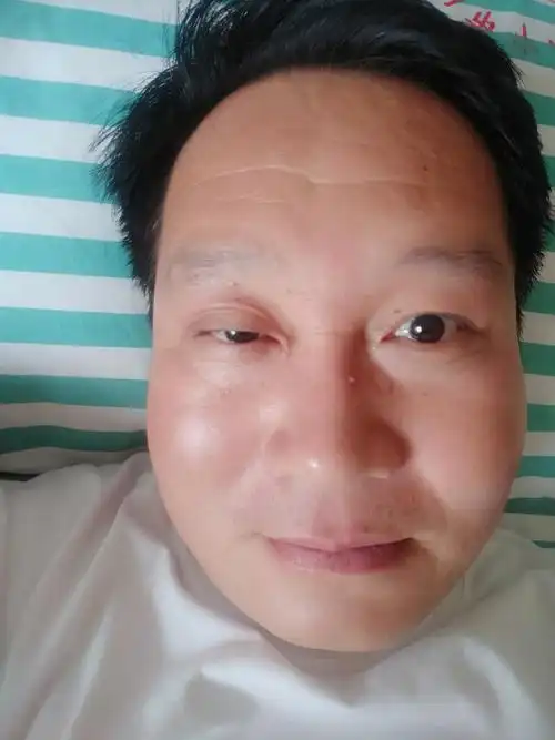 眼睑下垂治疗的漫长之路