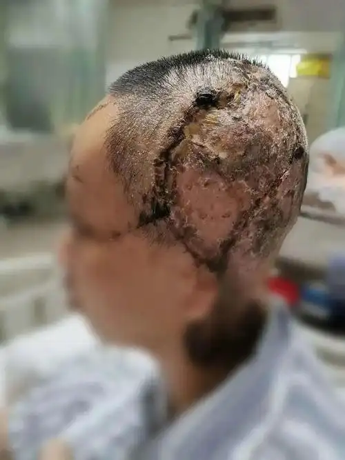 头皮发麻潮汕一女工秀发卷进机器整块头皮连带眉毛撕脱