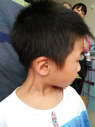 手术治疗先天性肌性斜颈的缺点有哪些?