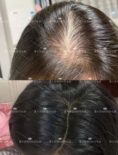 测评防脱发洗发水哪个牌子好用脱发自救指南