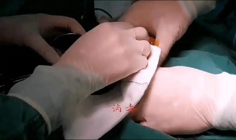 手术演示丨吻合器包皮环切术