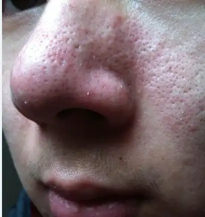 毛孔粗大里面垃圾多怎么办 每天都用洗面奶洗 但是第二天毛孔里面又有