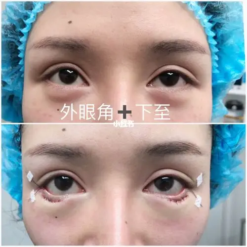 下睑下至77外眼角开大