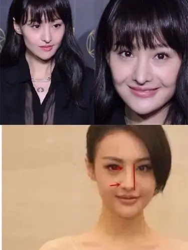 9797 近期郑爽出席时装盛典活动,因为她的"新鼻子"_圈子-新氧美容